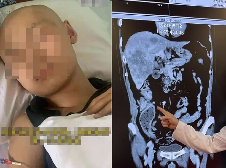 18-Year-Old Diagnosed with Stage 3 Colorectal Can.cer — Doctors Warn Young People Are Ignoring 2 Key Symptoms