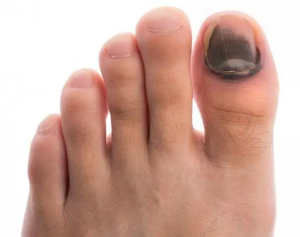 Black Toenail Explained: Causes, Meaning, and What to Do