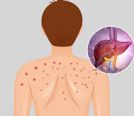 Fatty Liver: Causes, Symptoms, Treatment & Home Remedies