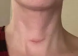 Severe jugular vein distension: a serious warning sign you shouldn’t overlook