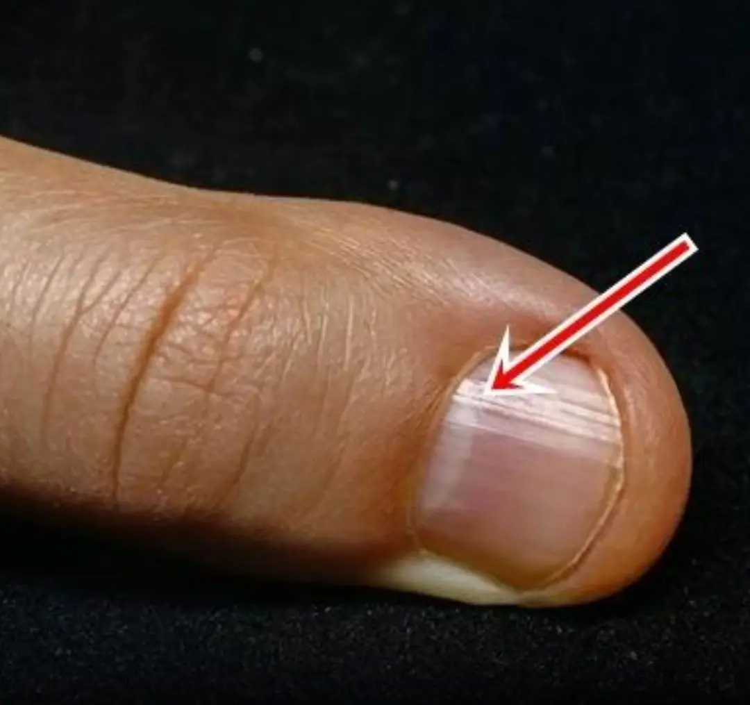 These Nail Lines After 40 Could Be Warning Signs — Here’s What They Mean