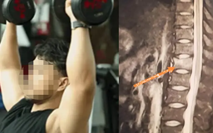 34-Year-Old Man Develops “Bones Like a 60-Year-Old” — Doctors Warn About a Daily Drink Many People Can’t Live Without