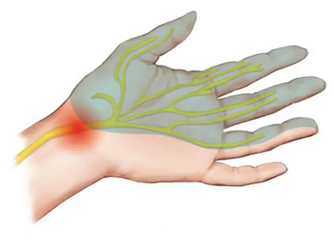 What does hand numbness mean - just discomfort or a deeper health issue?