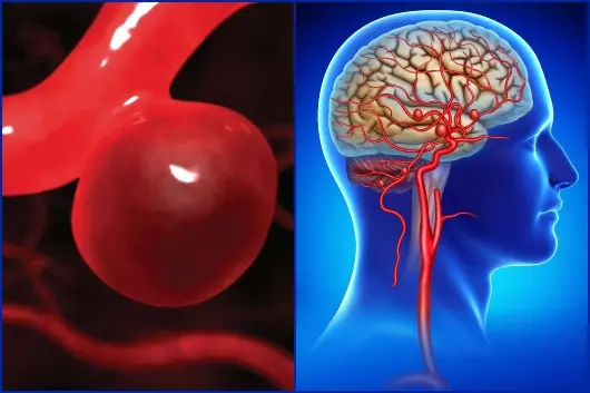 Aneurysm Warning Signs: What Your Body May Be Telling You