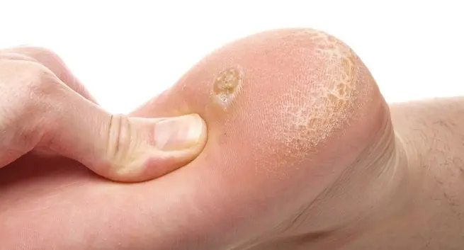 Plantar warts on the feet: what they are and why they’re often confused with calluses