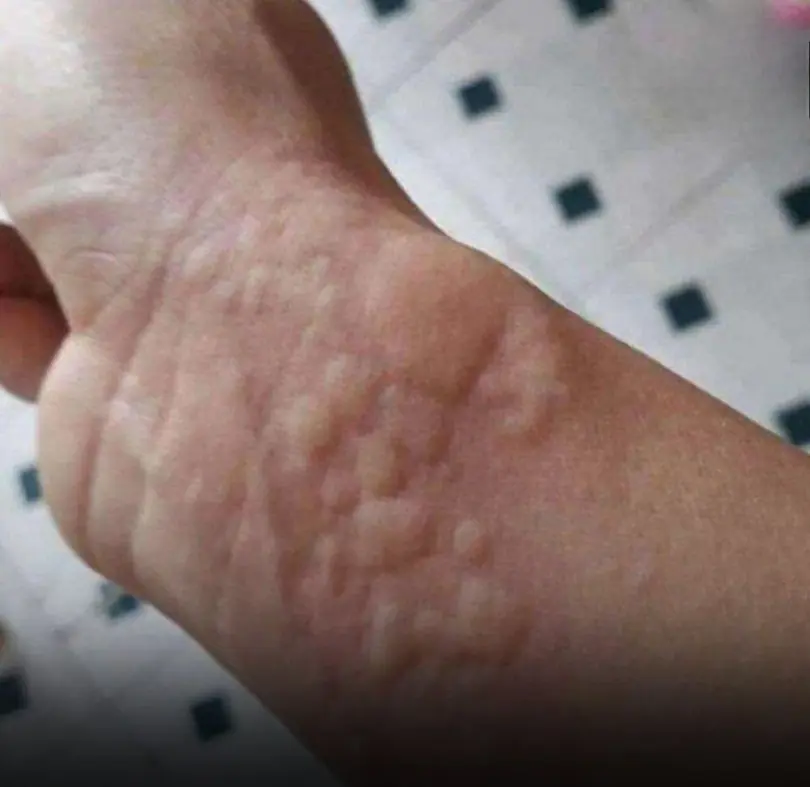 This ‘Simple Rash’ Could Turn Dangerous Fast