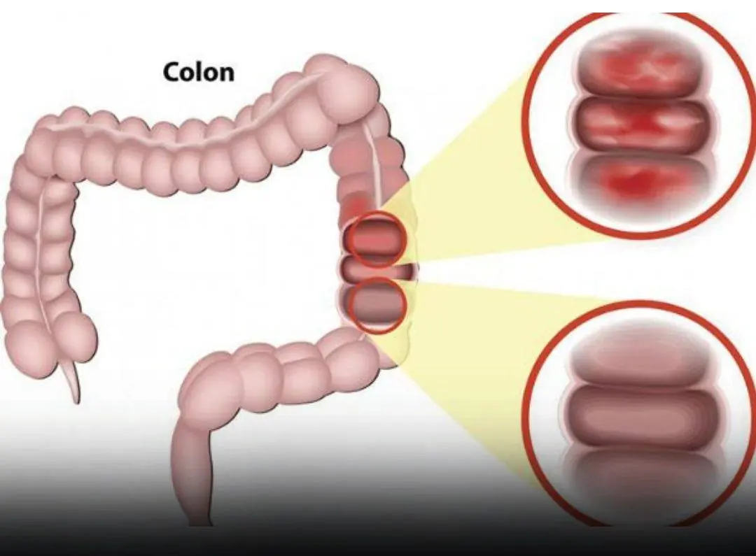 Don’t Ignore These 6 Early Indicators of Colon Can:cer