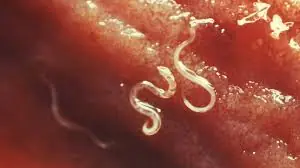Medical Experts Issue Warning: 4 Foods That May Harbor Parasites