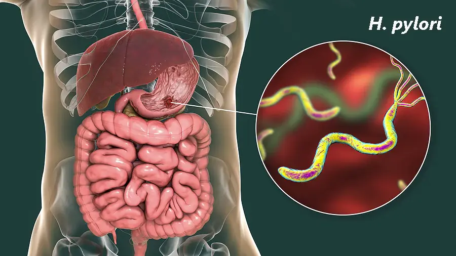 Symptoms of Helicobacter pylori You Should Never Overlook
