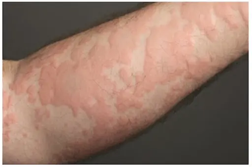 What He Thought Was Just an Allergy Turned Out to Be Something Far More Serious