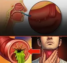 Can’t Get Rid of Phlegm in Your Throat? 4 Hidden Causes You Might Be Missing