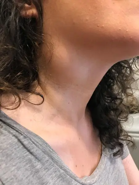 Body Lumps on the Neck: Causes, Warning Signs, and When to Act
