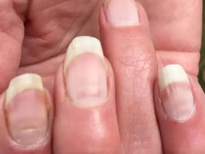 If You Notice These Lines on Your Nails After 40, Here’s What They Could Mean