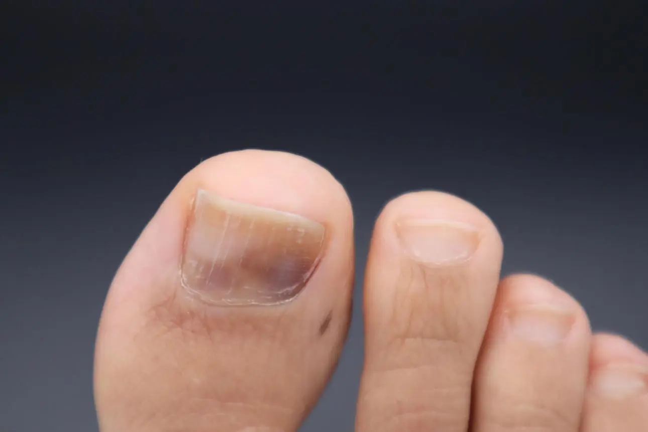 Black Toenails Explained: Causes, Risks, and What You Should Do