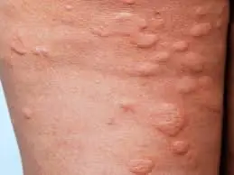If You Notice Itching and These Skin Bumps, It Might Be Time to Pay Attention…