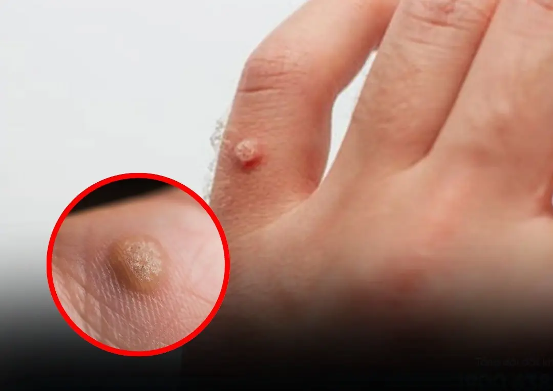 A Simple Solution for Warts and Skin Tags You Should Know