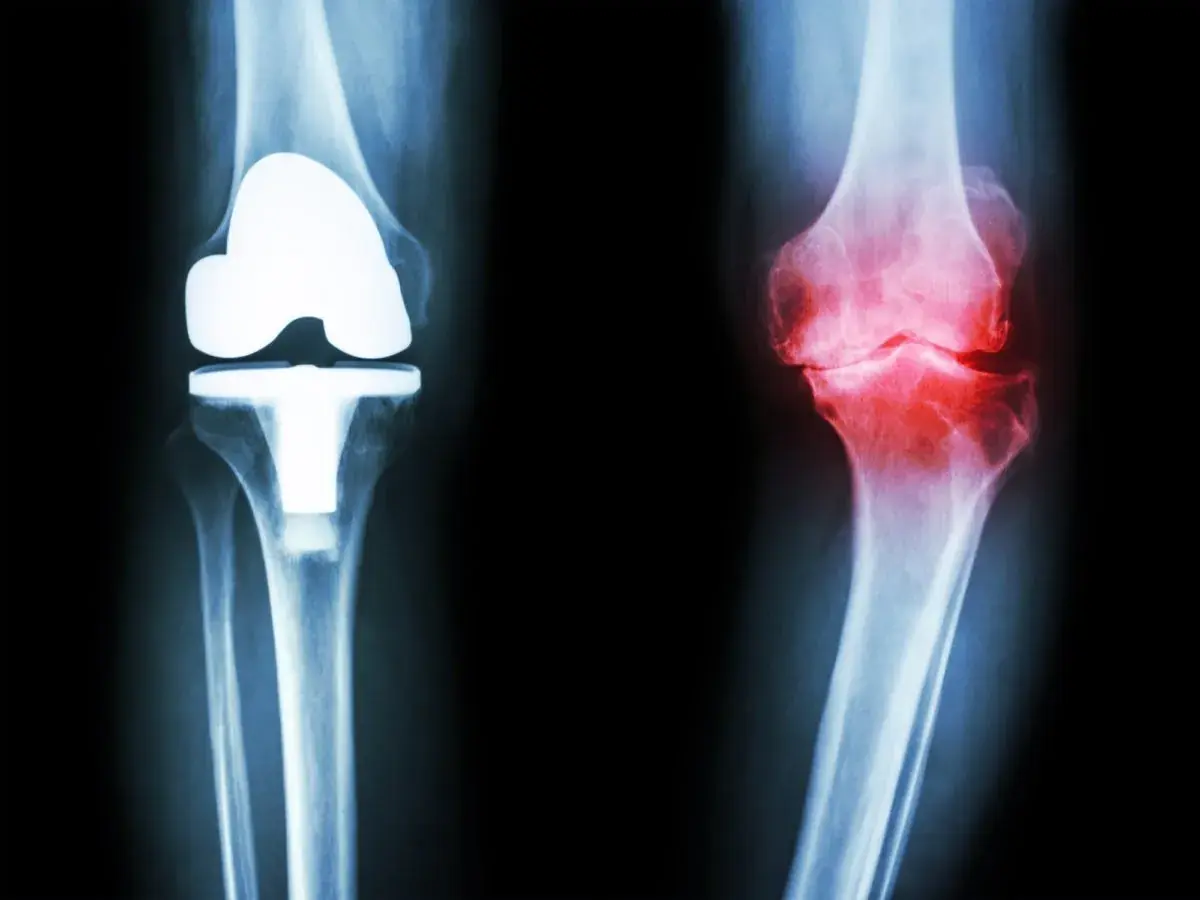 Knee Osteoarthritis: Recognize These 5 Common Symptoms Early