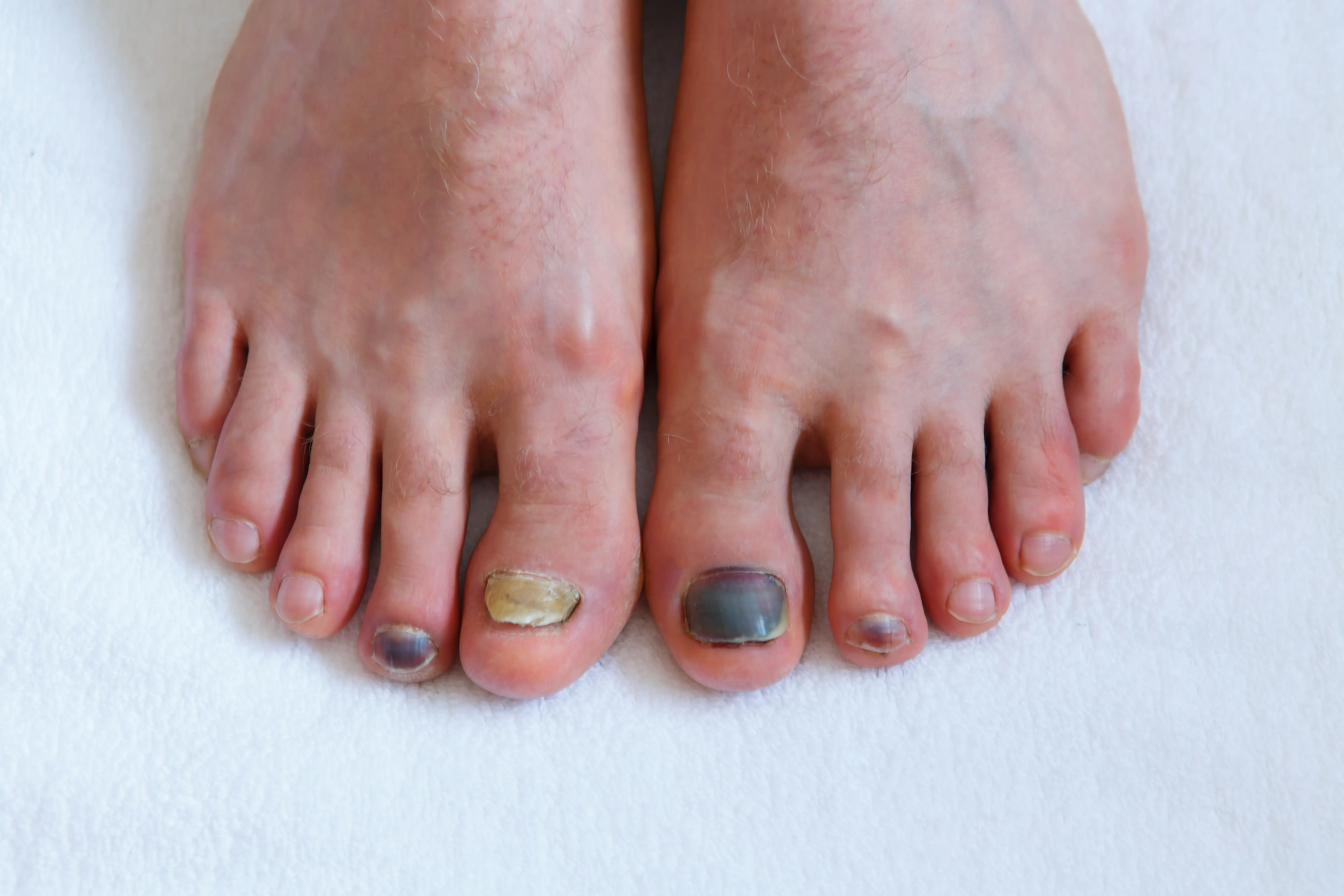 Black Toenail: What It Means and What You Should Do