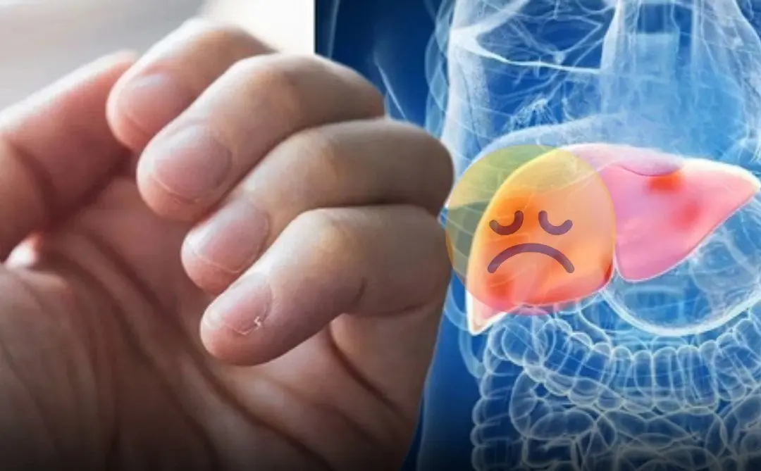 3 Hand Signs That May Signal Liver Failure — Even 1 Is a Reason to See a Doctor Immediately!
