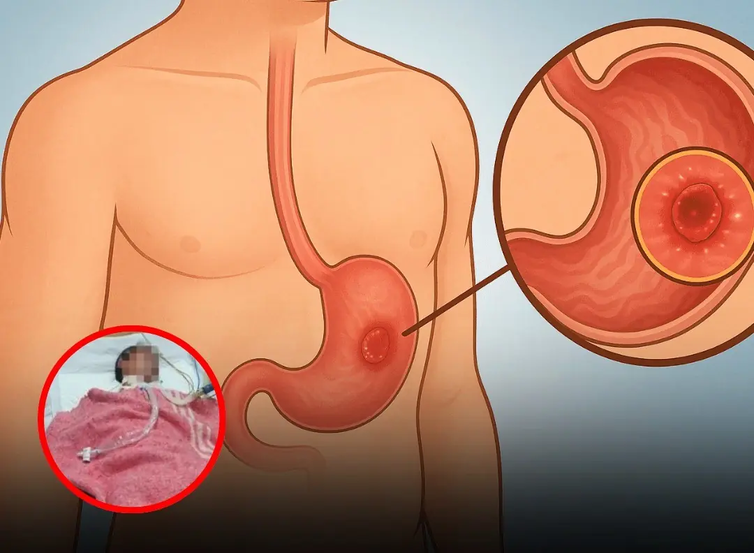 Doctor Highlights 3 Bedtime Habits That Could Affect Stomach Health After Woman’s Can:cer Case