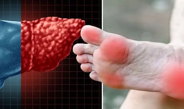 A Warning Sign in Your Feet Could Signal Advanced Fatty Liv.er Damage