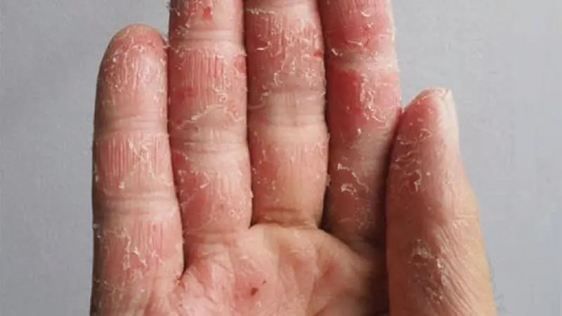 This Isn’t Just Dry Skin: What Your Hands Might Be Trying to Tell You