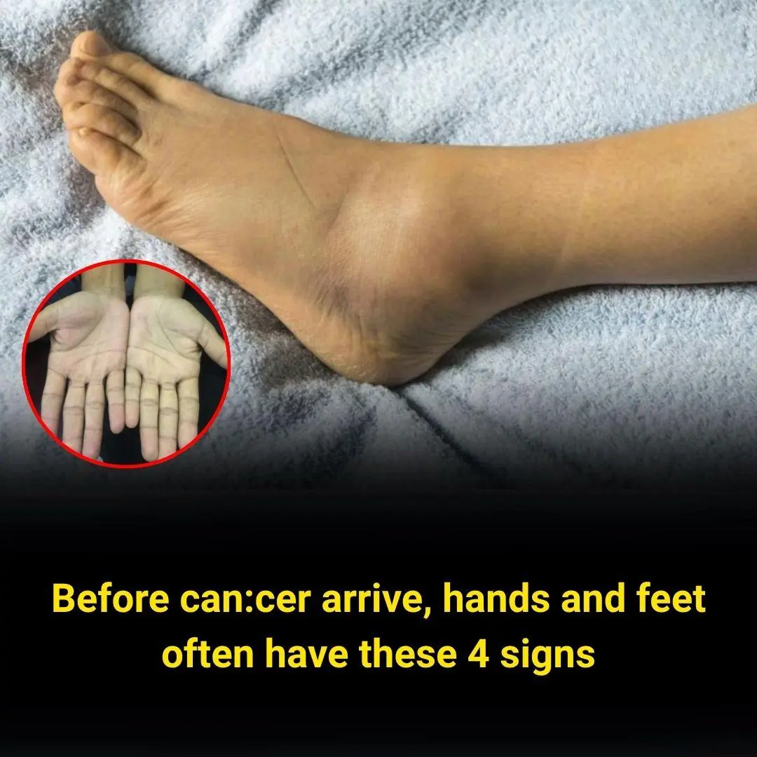 Before can:cer arrive, hands and feet often have these 4 signs