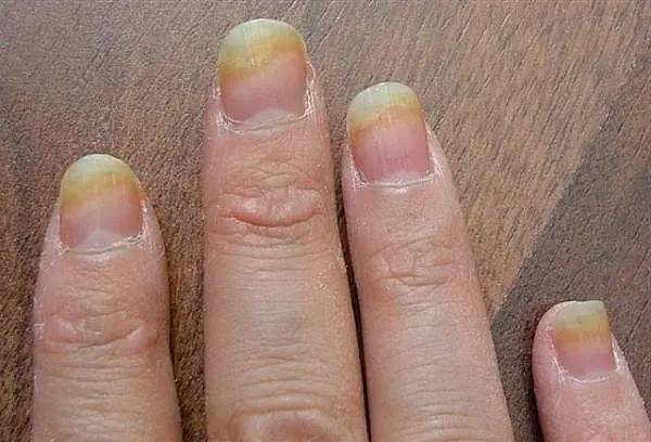 Experts have discovered a fingernail clue that may help predict how long you’ll live