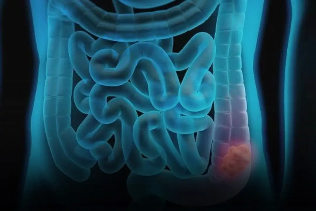 6 Key Indicators of Stage 1 Colon Can:cer and What They Mean
