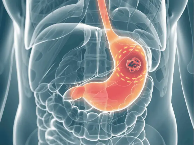 6 warning signs of stomach can.cer you need to take seriously