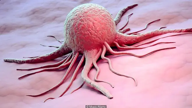 Doctors warn that 5 post-meal symptoms may signal the need for an early endoscopy to rule out can.cer