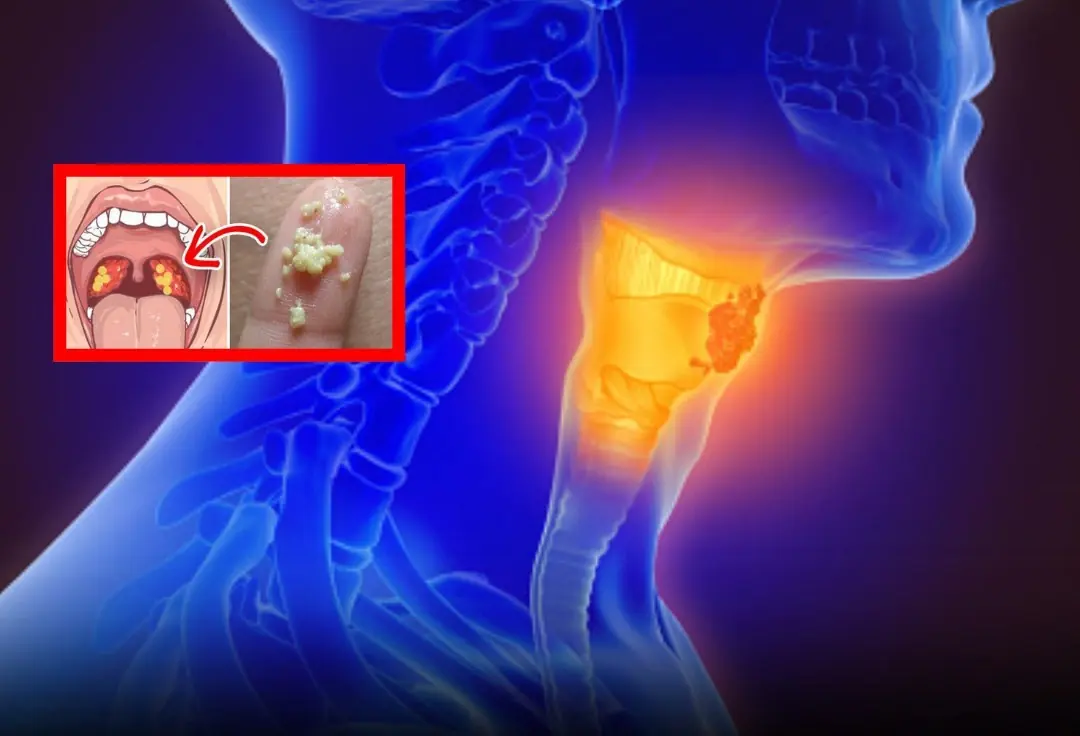 Unusual Throat Sensations Ending With a Small Lump: Causes and When to See a Doctor