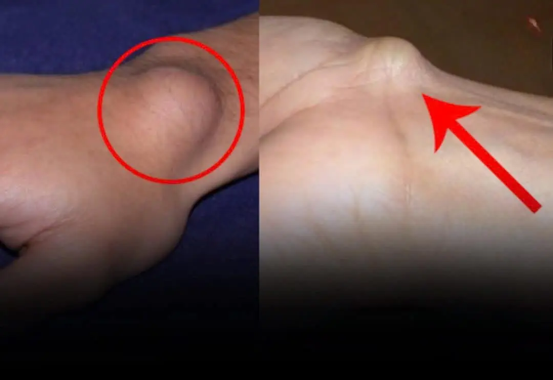 Notice an unusual lump on your wrist? It could be a warning sign of a serious illness