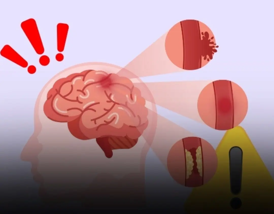 3 Things You Should Never Do After Meals and 4 Before Bed to Prevent Stroke