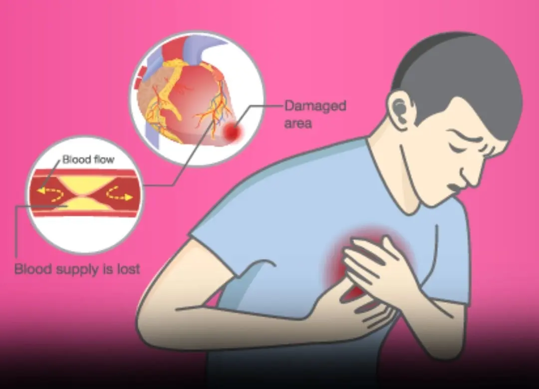 Watch for These 10 Signs Linked to Stroke Risk and Early Mor:tality