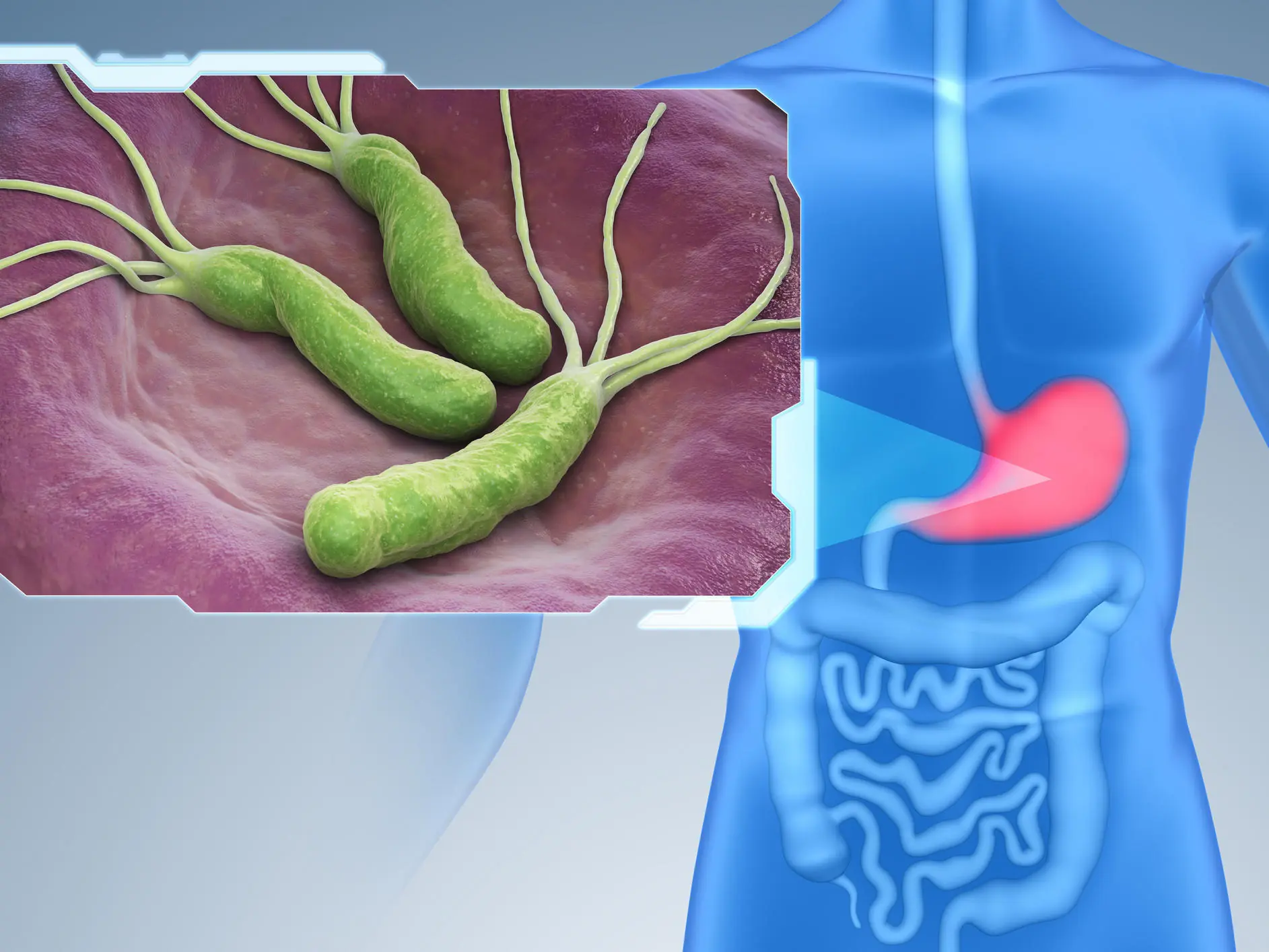 H. pylori Infection Is Rising — 5 Warning Signs You Should Never Ignore