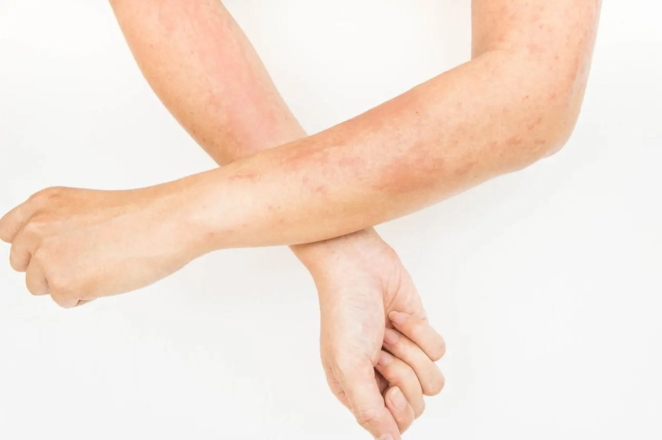 Hives and Breathing Changes: Warning Signs You Should Never Ignore