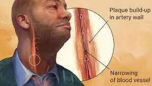 10 Indicators of Blocked Arteries You Shouldn’t Ignore