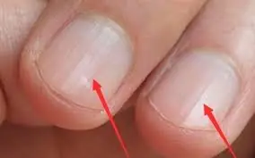 Lines on your nails may indicate nutritional deficiencies or other health issues.