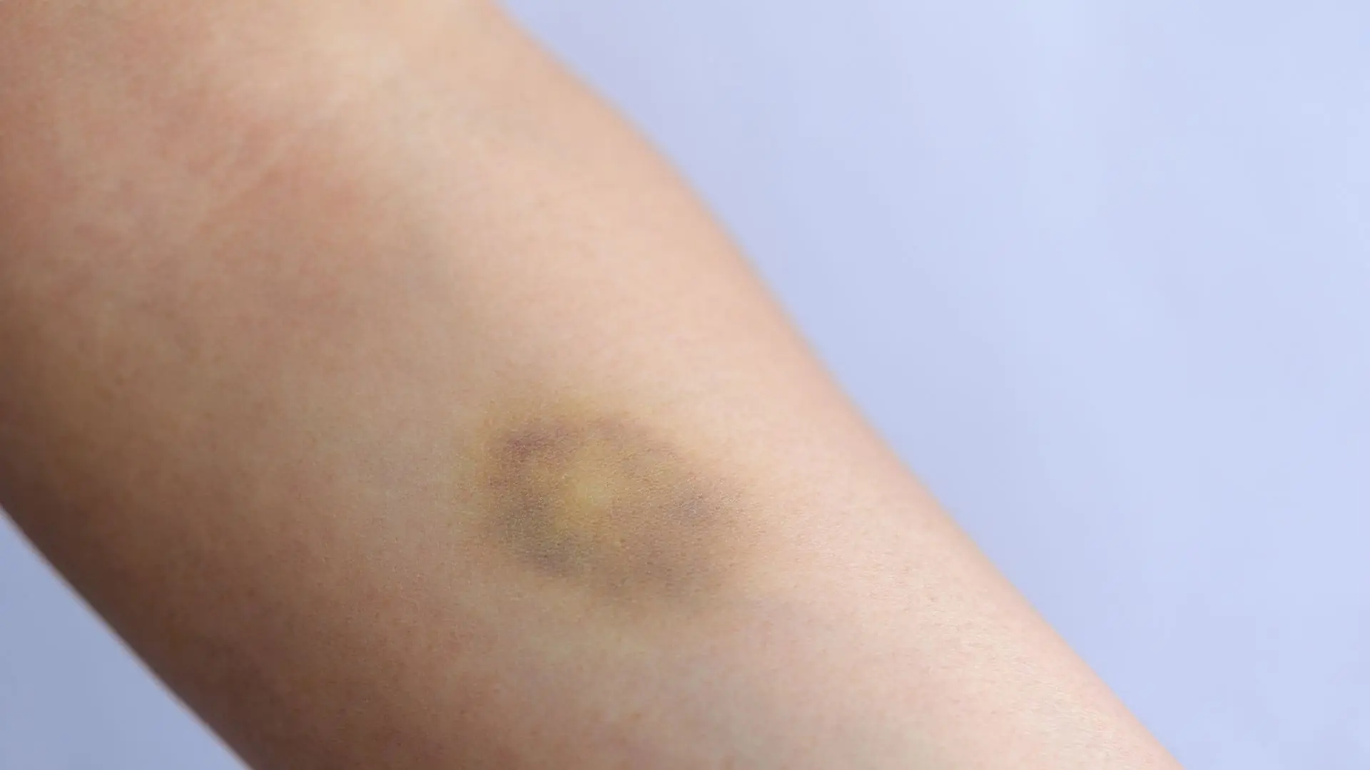 These types of bruises on your body may reveal important health clues