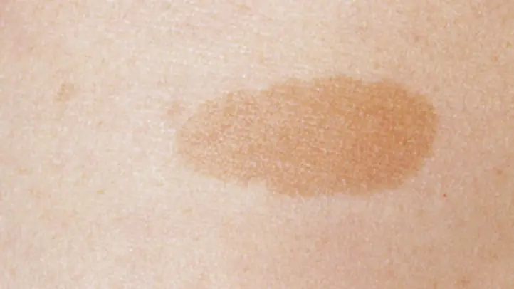 Latest Research Confirms: Why These Spots Appear — And When You Should Be Concerned