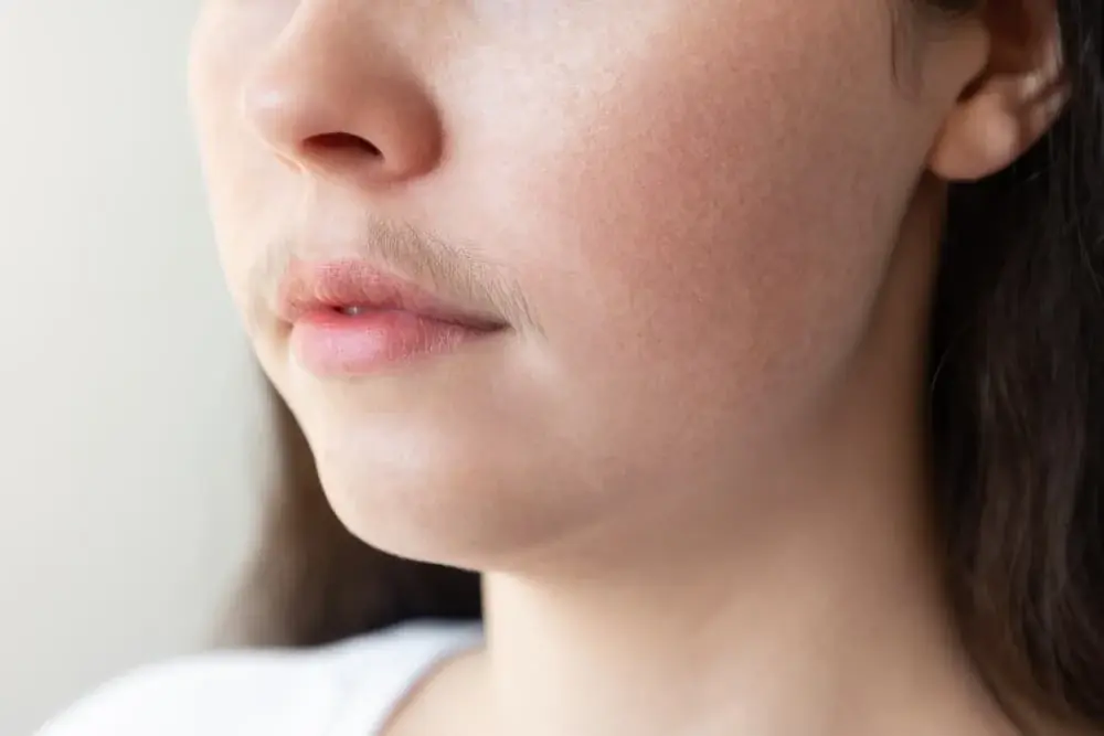 What causes chin hair in women? Hormones, reasons, and treatment options