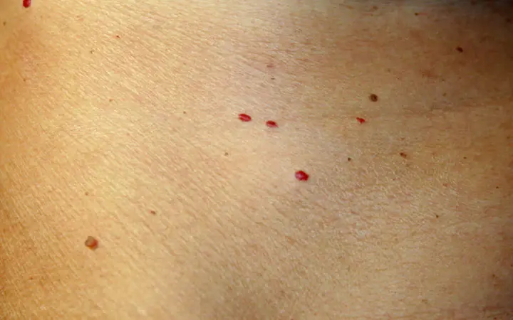 Spotted Red Dots on Your Skin? Here’s Why You Shouldn’t Ignore Them