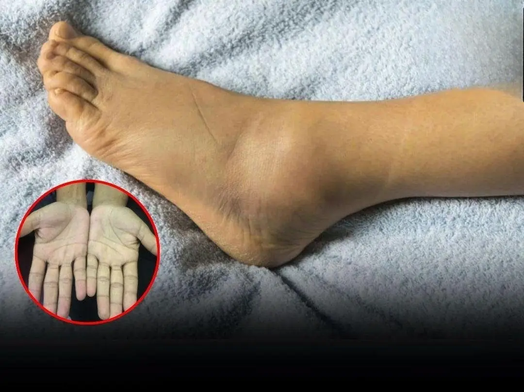 Watch for these 4 changes in your hands and feet that may signal can.cer early