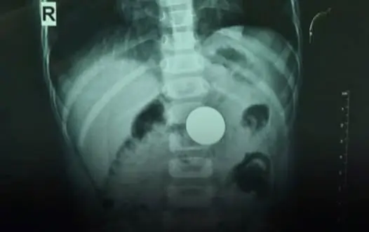 A 3-year-old girl tra.gically pa.ssed away while playing with her father, and the au.topsy