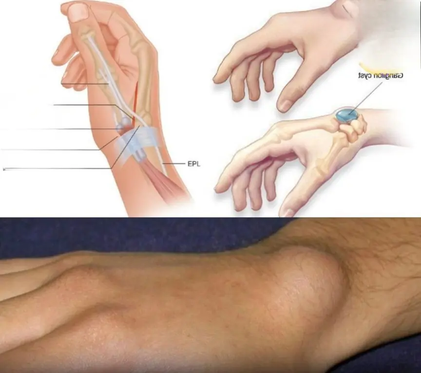 Notice this bump on your wrist? Don’t ignore it