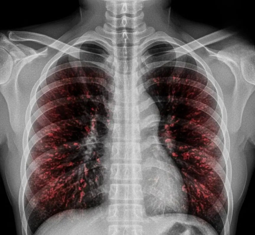 The Surprising Rise of Lung Can.cer in Non-Smokers and Its Possible Causes