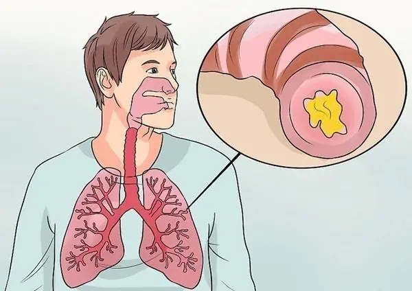 It’s rarely explained by doctors, yet constant phlegm often stems from 4 hidden causes