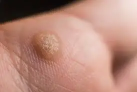 What You Need to Know About Using Hydrogen Peroxide on Skin Tags and Warts