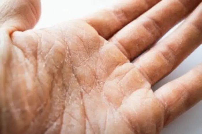 If you notice this on your hands, it’s more than dry skin - it could be an important health signal